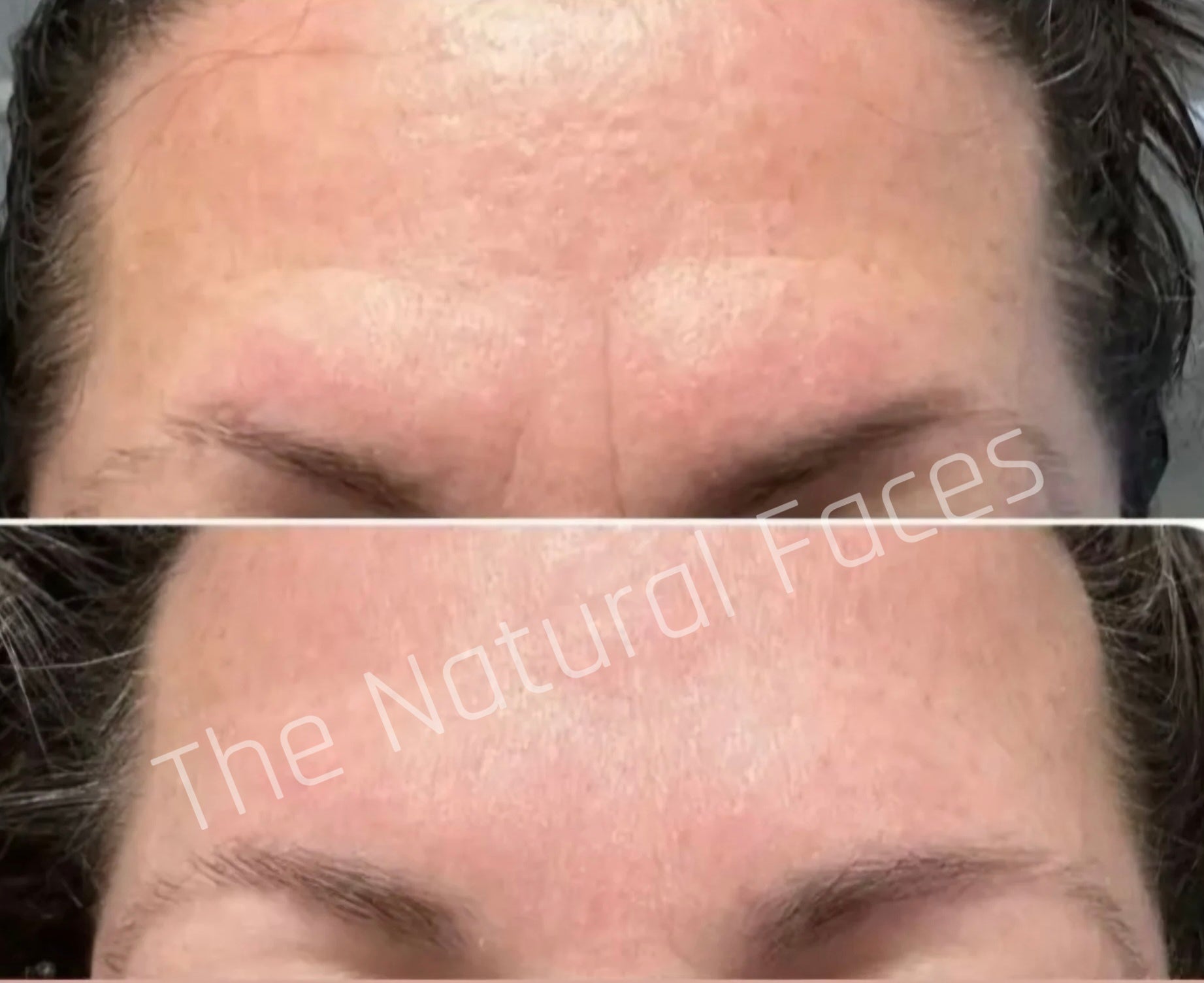 Japanese Face Tape™ - Forehead Pro