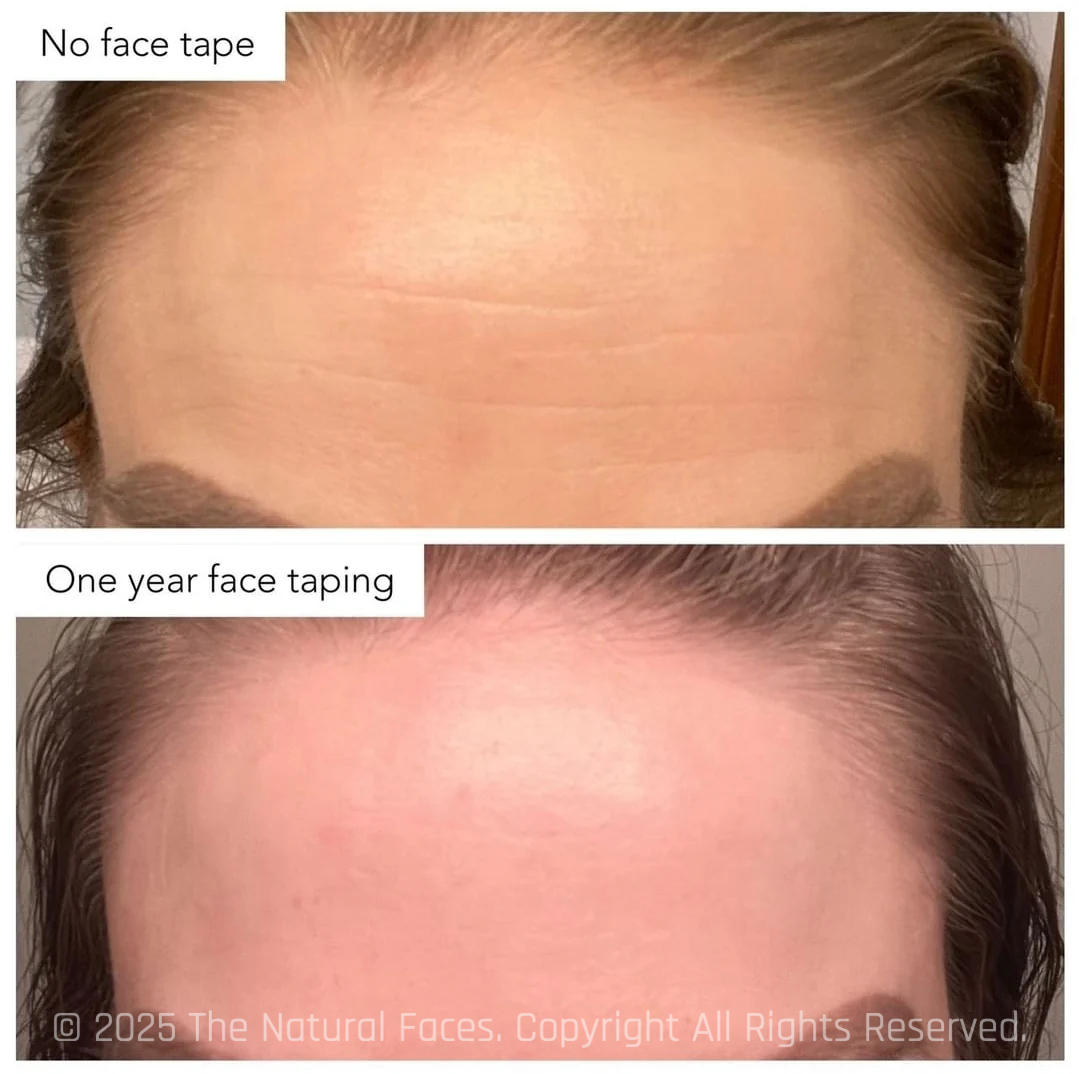 Japanese Face Tape™ - Forehead Pro